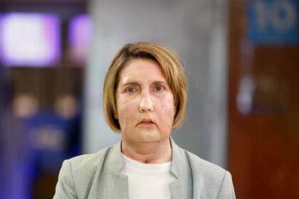 Vall d’Hebron realiza primer trasplante facial con donante tras eutanasia