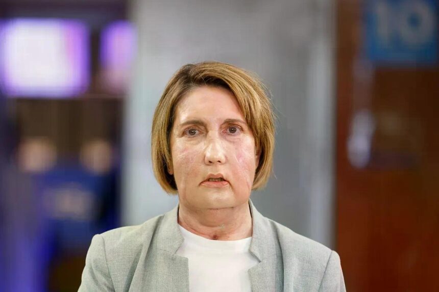 Vall d’Hebron realiza primer trasplante facial con donante tras eutanasia